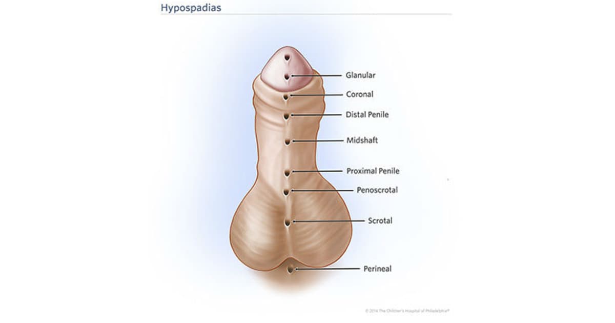 Hypospadias and UDT Treatment
