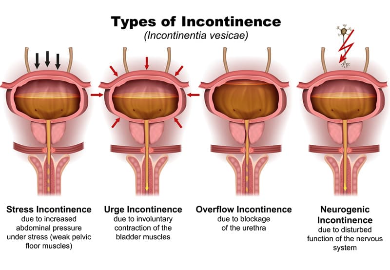 Doctor discussing incontinence treatment options with patient