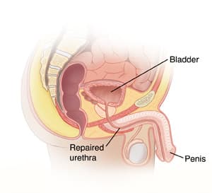 Urethroplasty Surgery