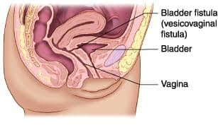 Urinary Fistula Treatment