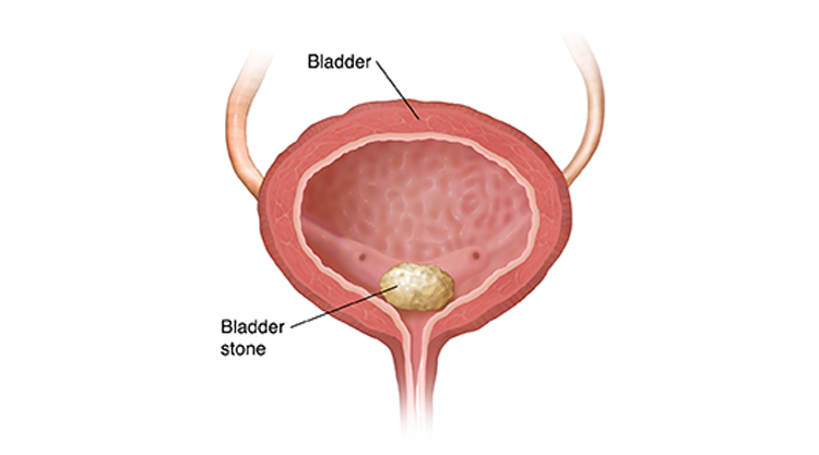 Bladder Stone Anatomy