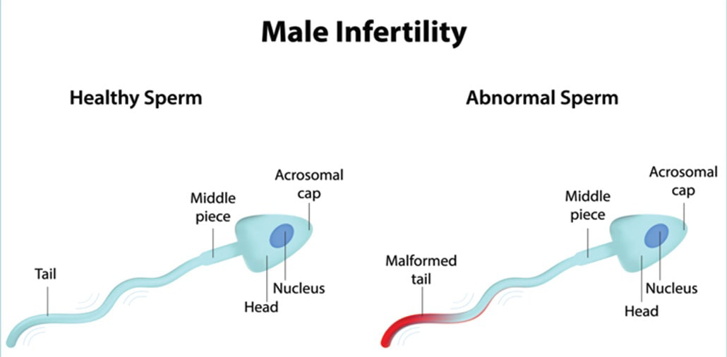Male Infertility Illustration