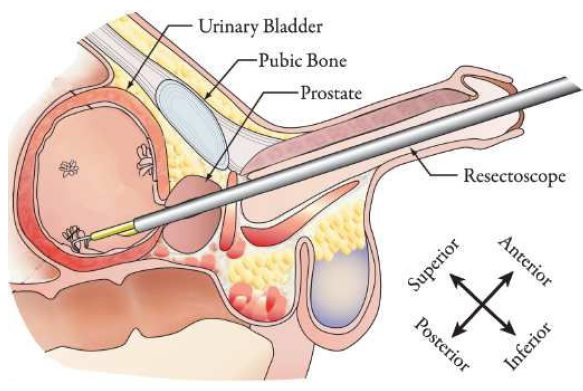 18.5 French Procedure