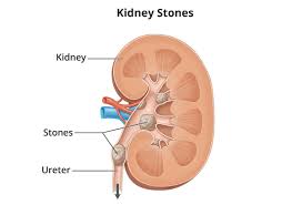 Renal Stone Procedures