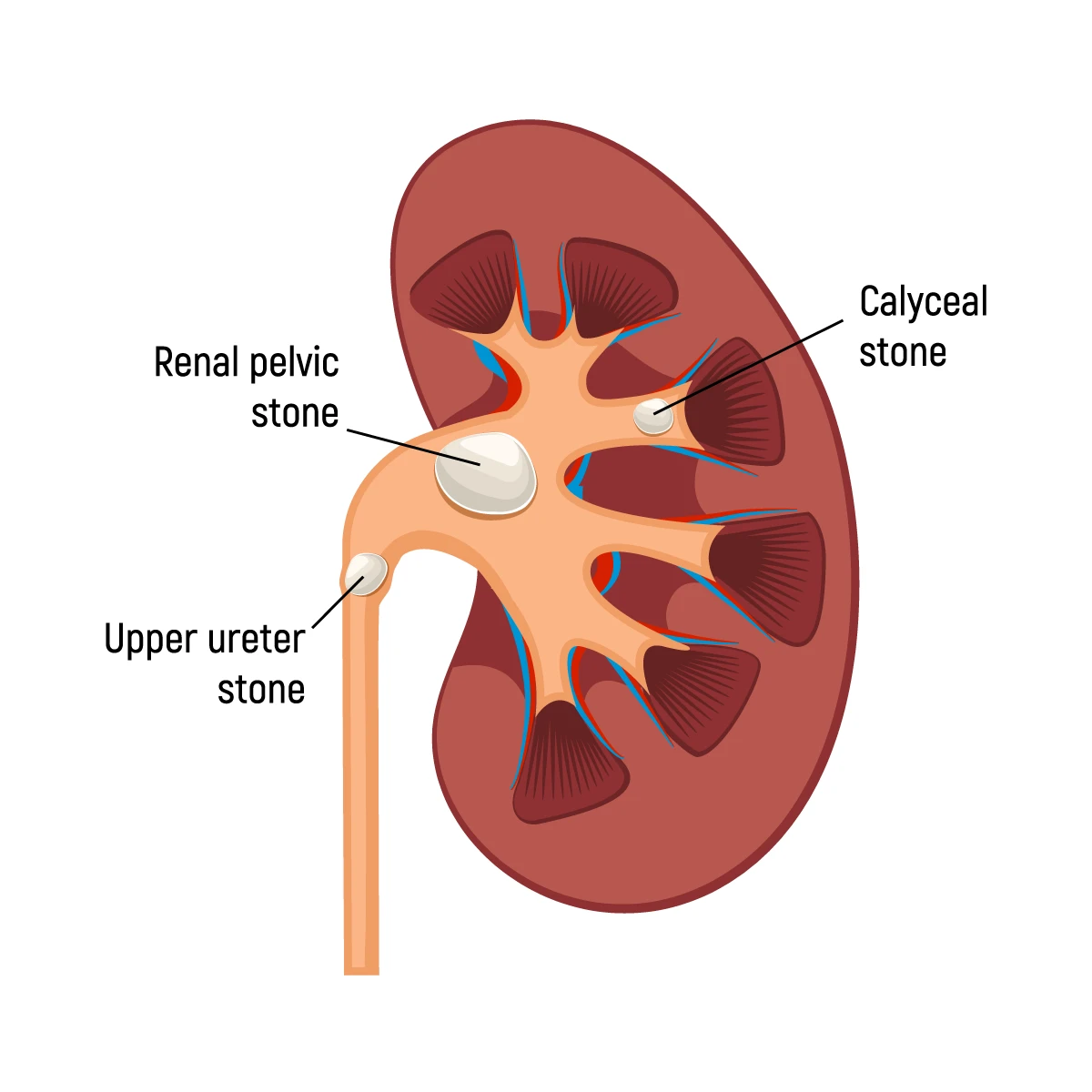Ureteric Stone Anatomy
