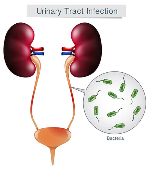Urinary Disease Illustration